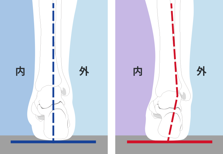 かかとが真っ直ぐな足とかかとが外に傾いた足の比較図